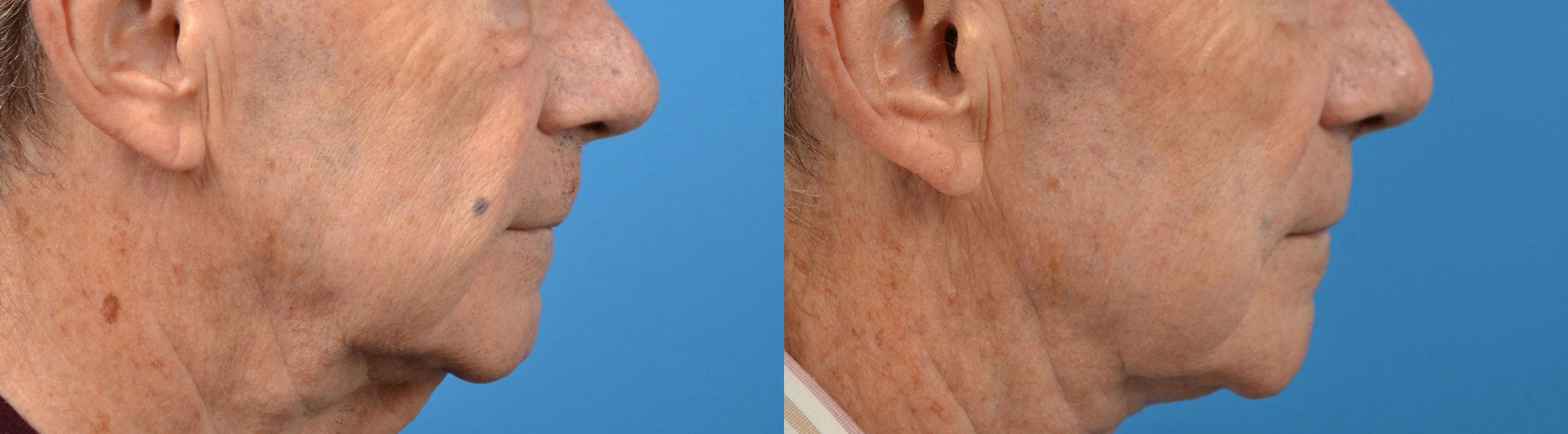 nasolabial-folds-photos-melbourne-fl-patient-57938